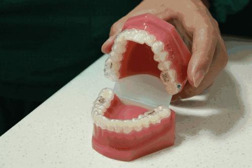 1601383300203451.jpg How Long Does Adult Teeth Straightening Take? Dr.Clear Aligner Explains