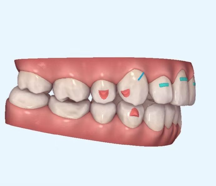 Clear Aligner