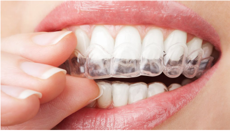 How Much Does Dr.Clear Aligner Treatment Cost