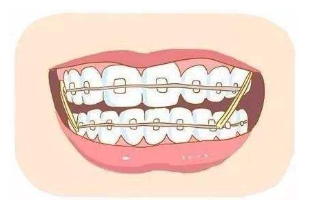 1603635342551147.png Important Notes During Dr.Clear Aligner Treatment