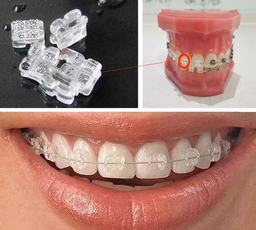 What are the advantages of Dr.Clear Aligner