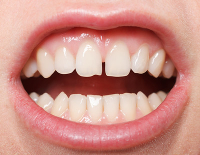 What to Do If Your Clear Aligner Treatment Relapses? Don't Worry, Dr.Clear Aligner Tells You How