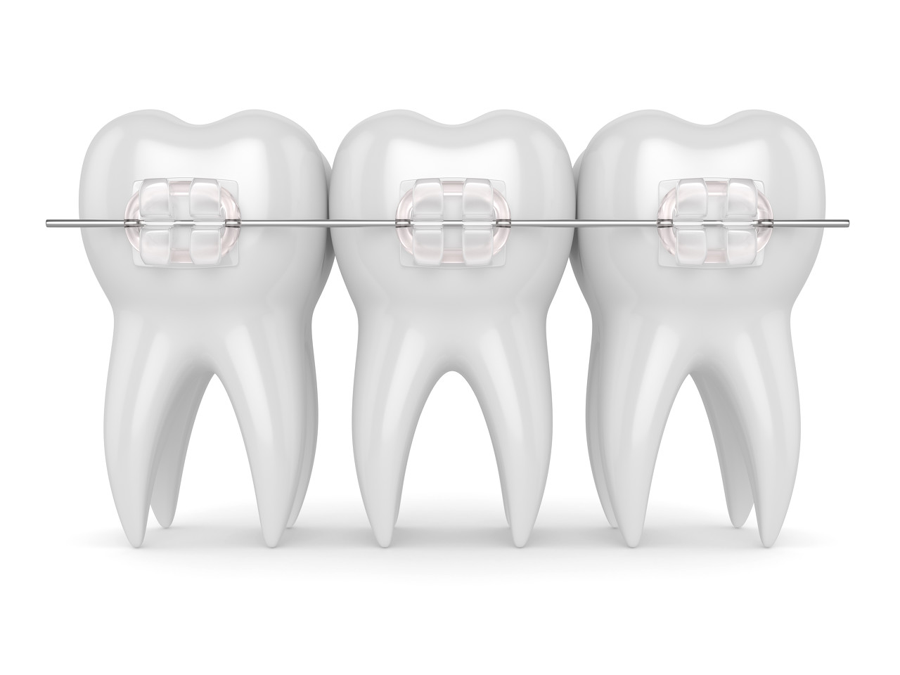 What are the differences between traditional orthodontics and clear aligners
