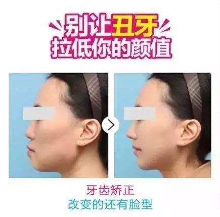 What is the typical age for Dr.Clear Aligner treatment?