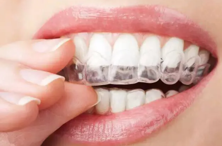 Common Types of Braces and Things to Know
